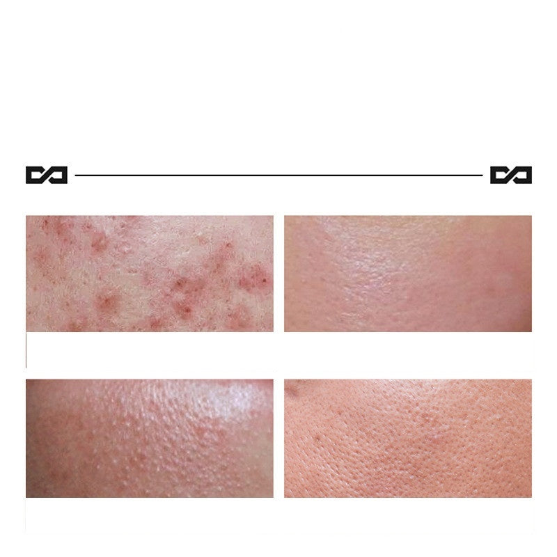 ✨ Acne Treatment Repair Cream