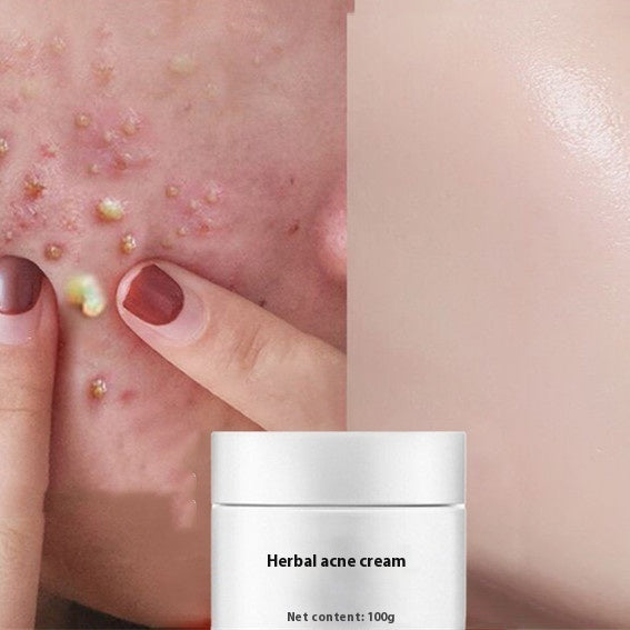 ✨ Acne Treatment Repair Cream